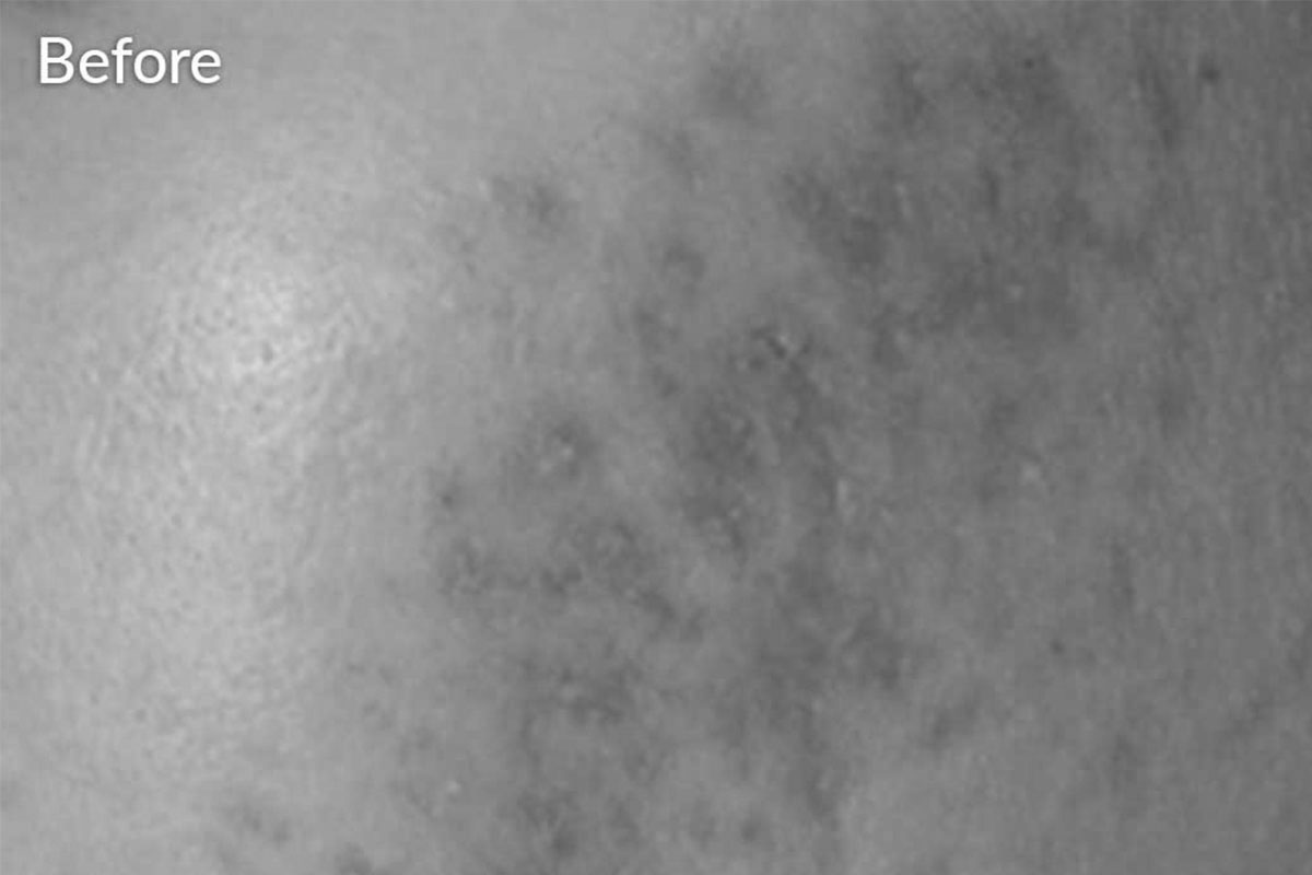 before microneedling in Los Gatos