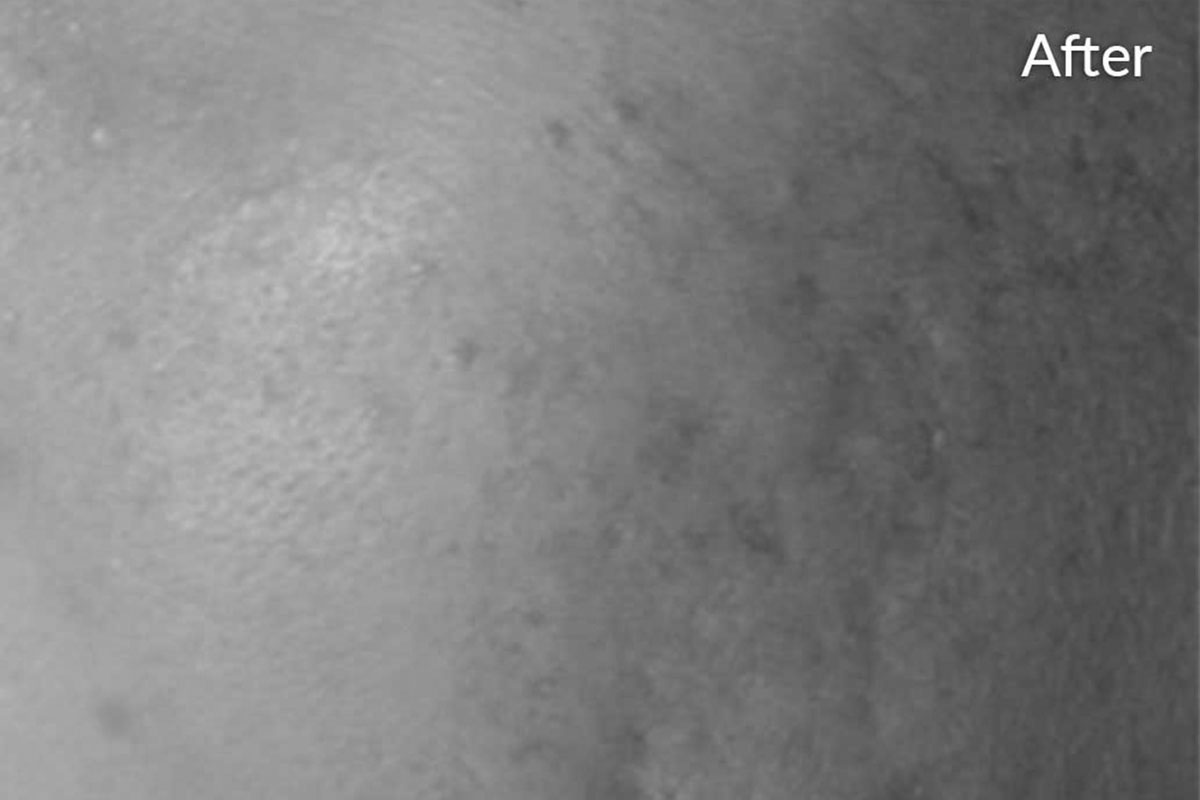 after microneedling in Los Gatos
