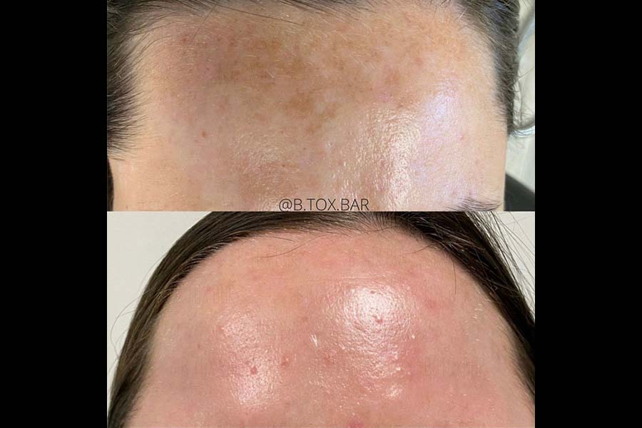 Chemical Peels in Los Gatos, CA | B.TOX.BAR
